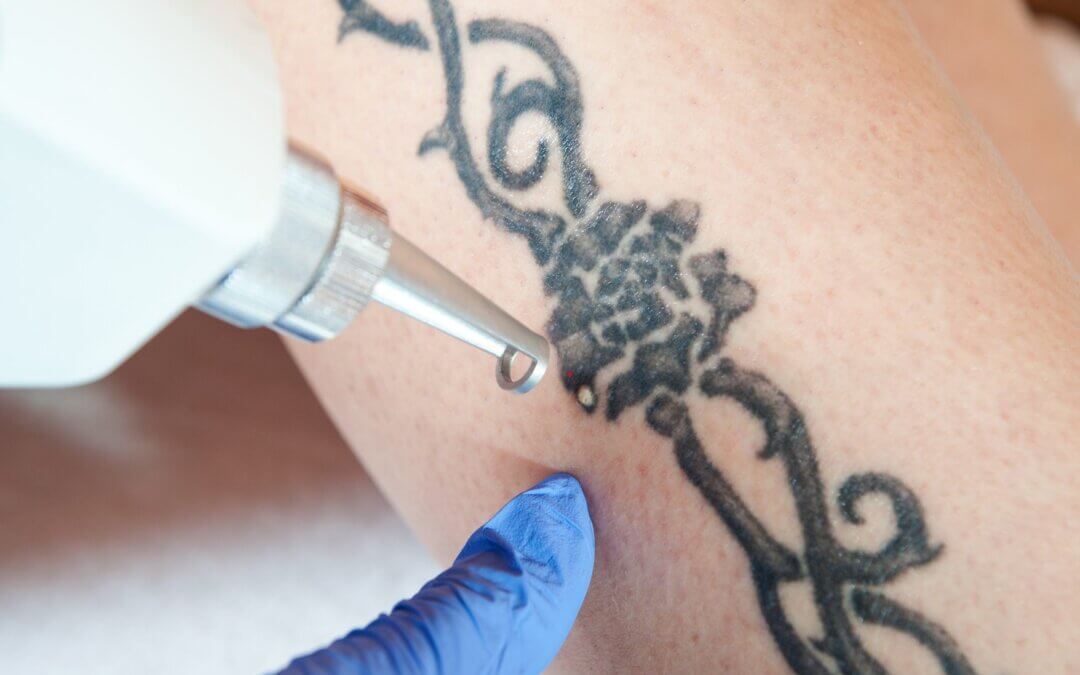 Affordable Tattoo Removal Options in Las Vegas