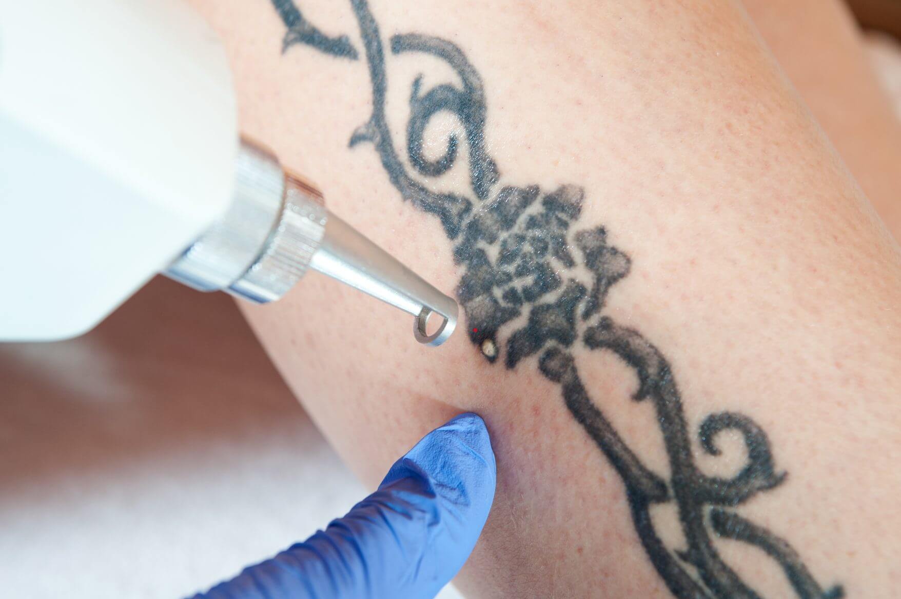 Affordable Tattoo Removal Options in Las Vegas