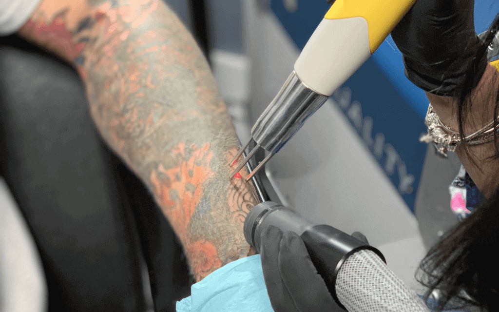 Emergency Tattoo Removal in Las Vegas: Swift Solutions