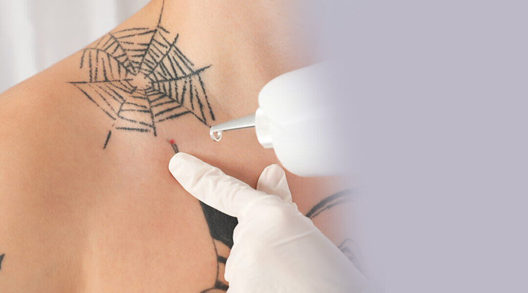 Las Vegas Tattoo Removal Services