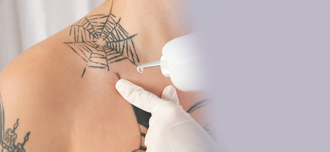 Las Vegas Tattoo Removal Services