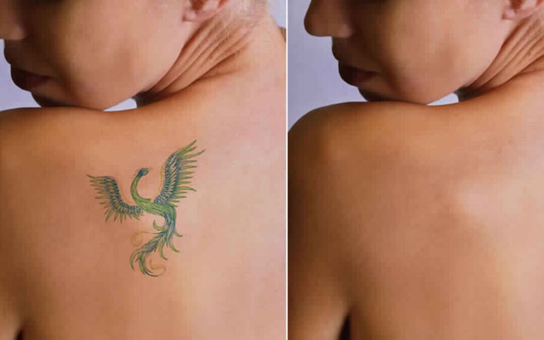 Tattoo Removal Before and After Las Vegas