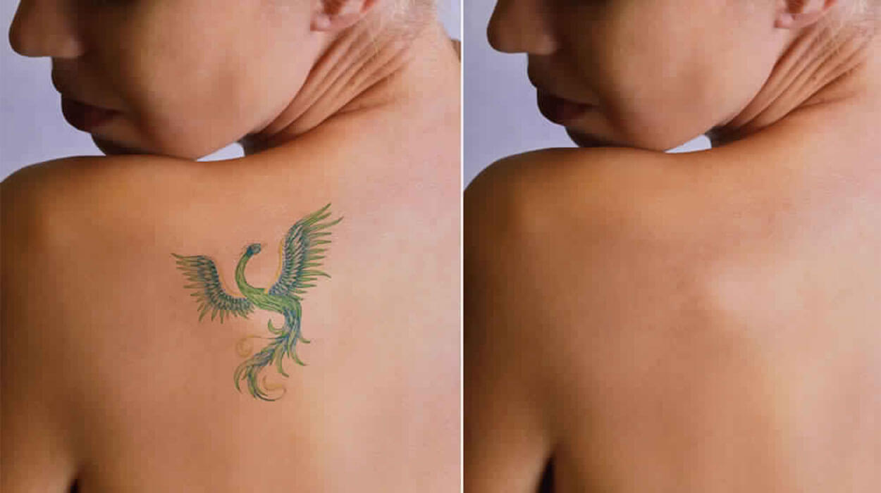 Tattoo Removal Before and After Las Vegas