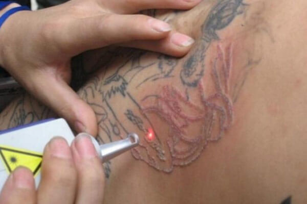 best laser tattoo removal near me