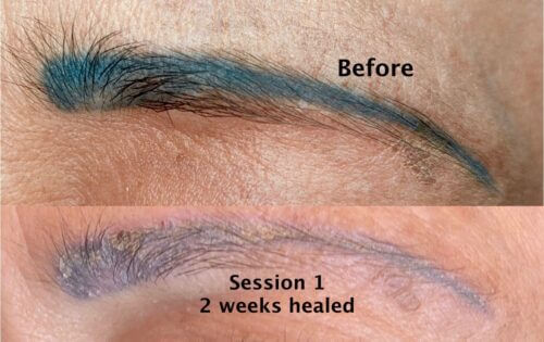 brow tattoo removal near me