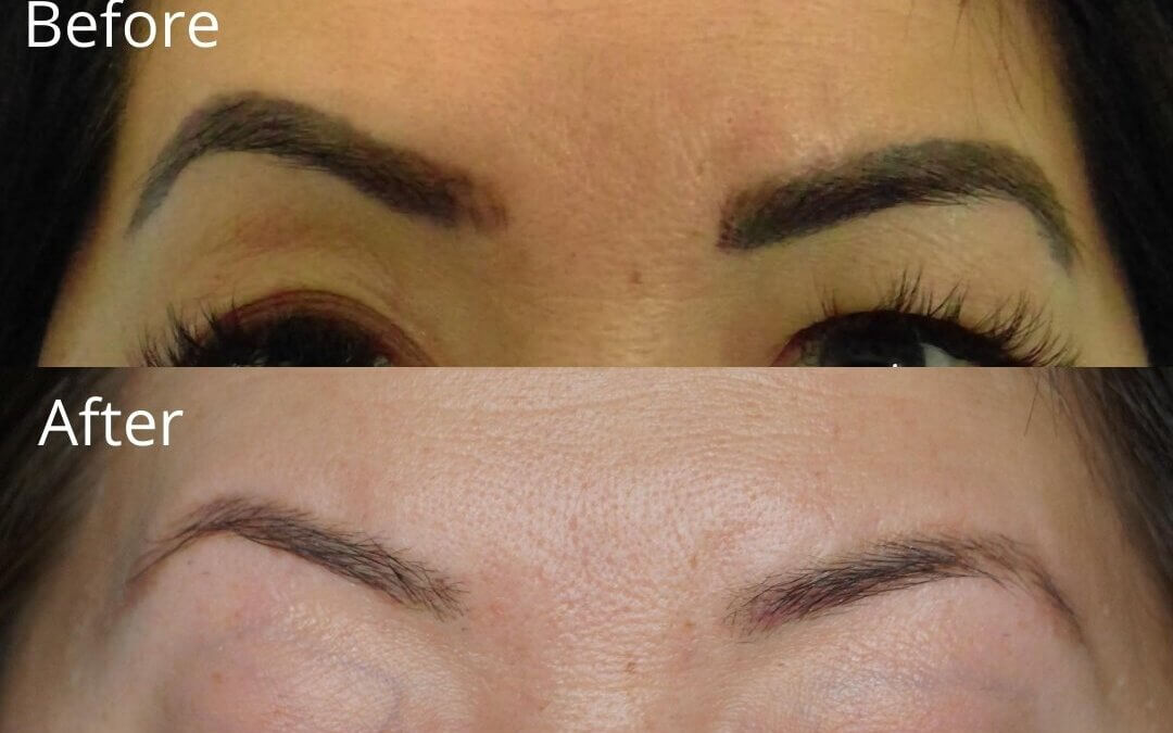 pico laser eyebrow tattoo removal