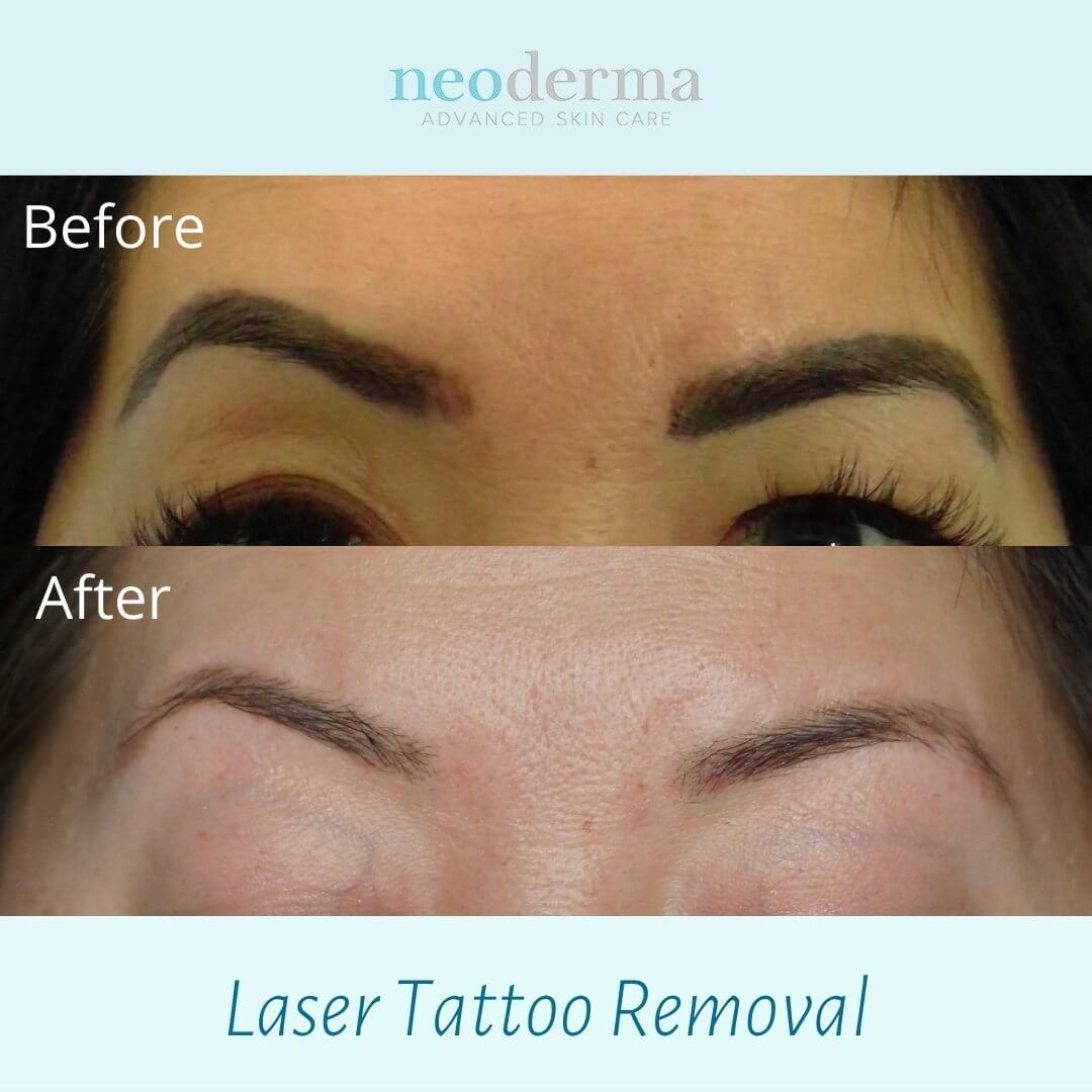 pico laser eyebrow tattoo removal