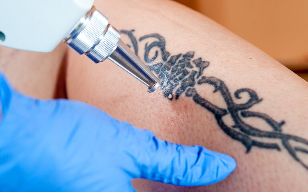 how much tattoo removal cost