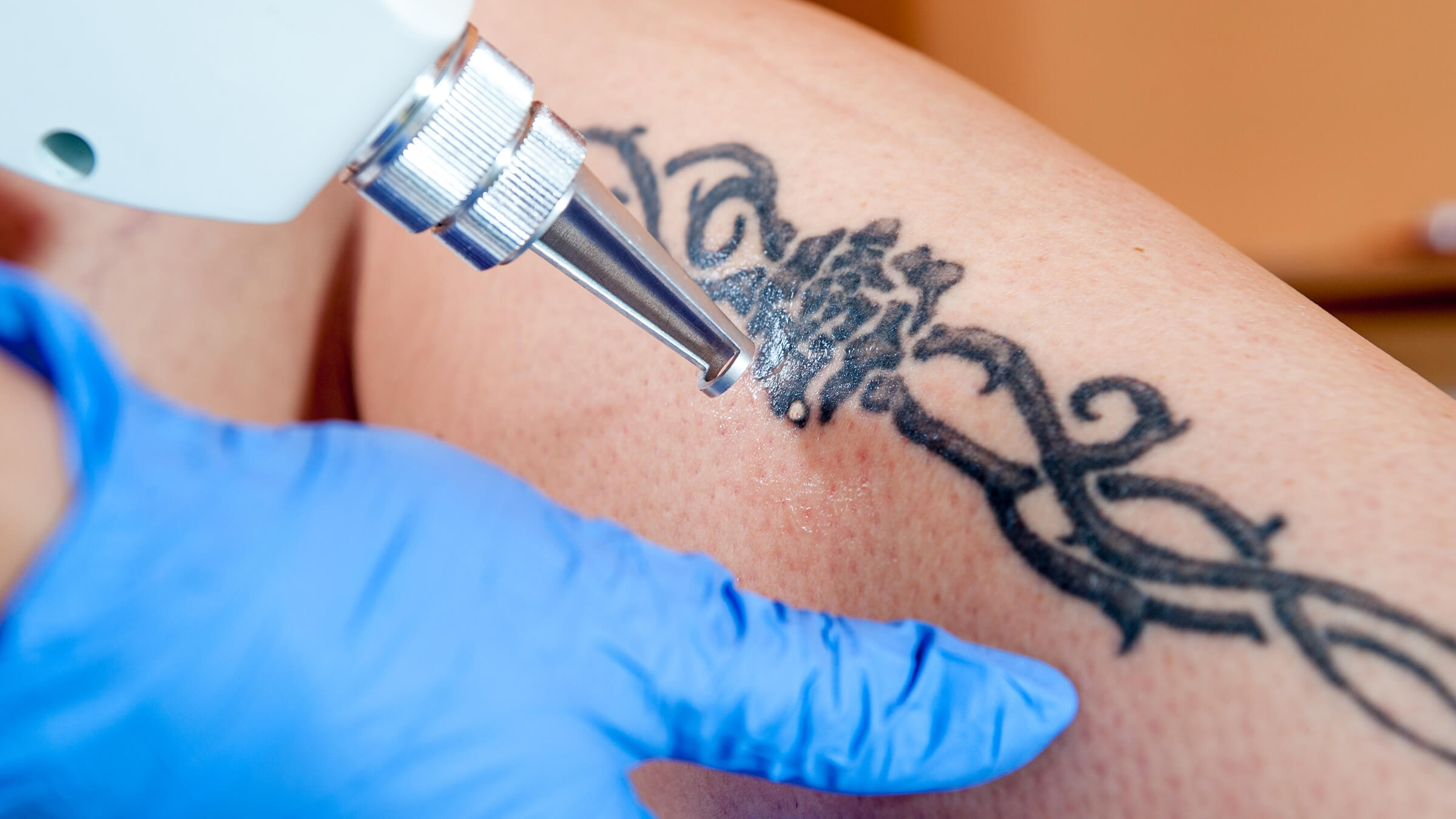 how much tattoo removal cost