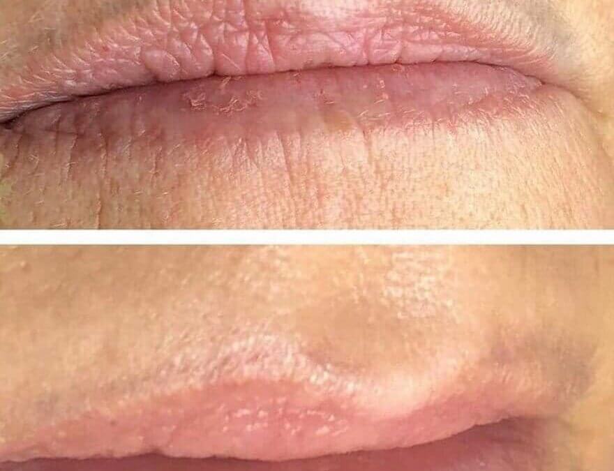 lip tattoo removal