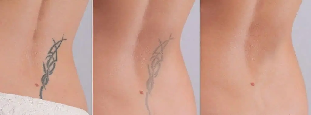 Tattoo Removal Near Me