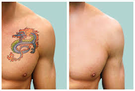 tattoo removal