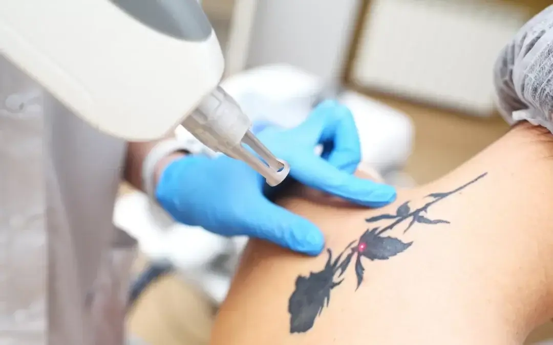 Surgical Tattoo Removal in Las Vegas