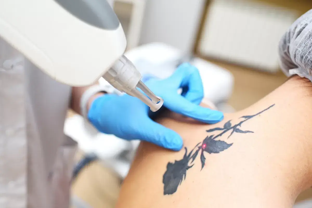 Surgical Tattoo Removal in Las Vegas