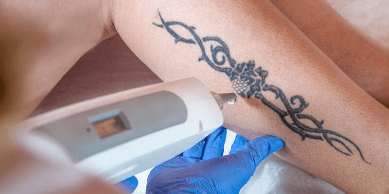 Serenity tattoo removal las vegas nv