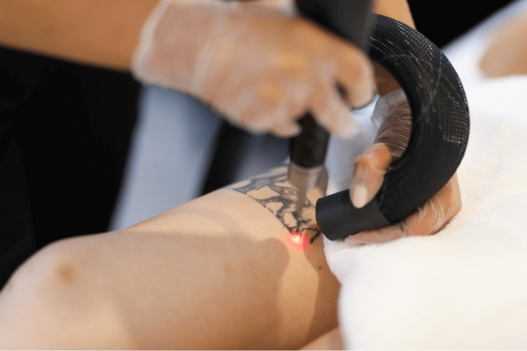 Pico Laser Tattoo Removal Las Vegas