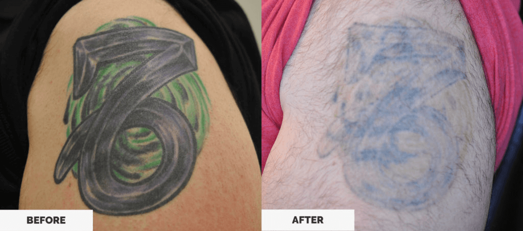 Las Vegas Dermatology Tattoo Removal