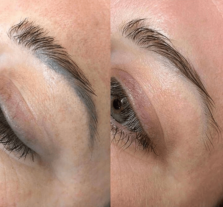 microblading removal